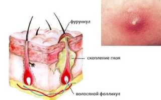 Из-за чего вылезает фурункул на ягодицах? Узнайте причины и советы
